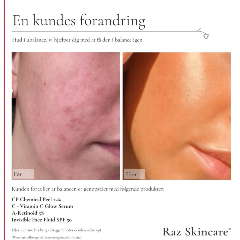 RAZspa A-retinoid 5% 30 ml - Billede 3
