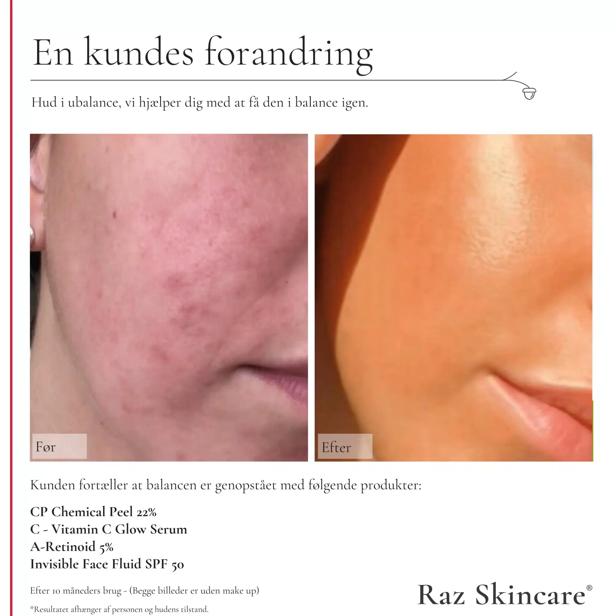 RAZspa A-retinoid 5% 30 ml - Billede 3