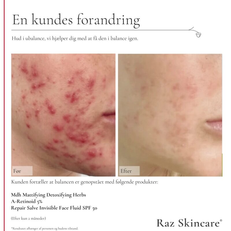 RAZskincare Mdh ansigtsserum 30 ml - Billede 3
