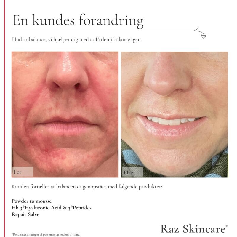 RAZskincare Hh ansigtsserum 30 ml - Billede 2